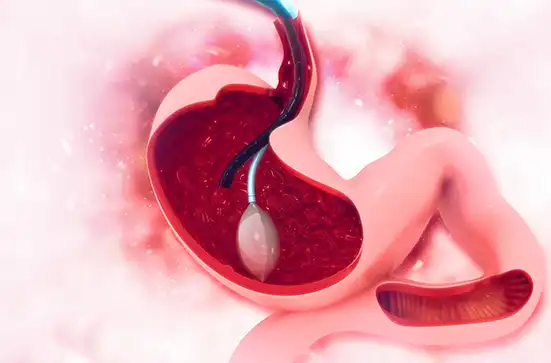 gastric balloon treatment in turkey for uk patients