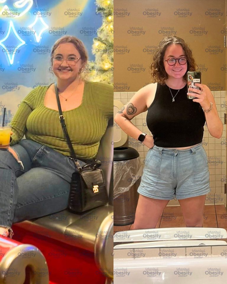 Gastric Balloon Treatment Abroad: A Guide for UK Patients